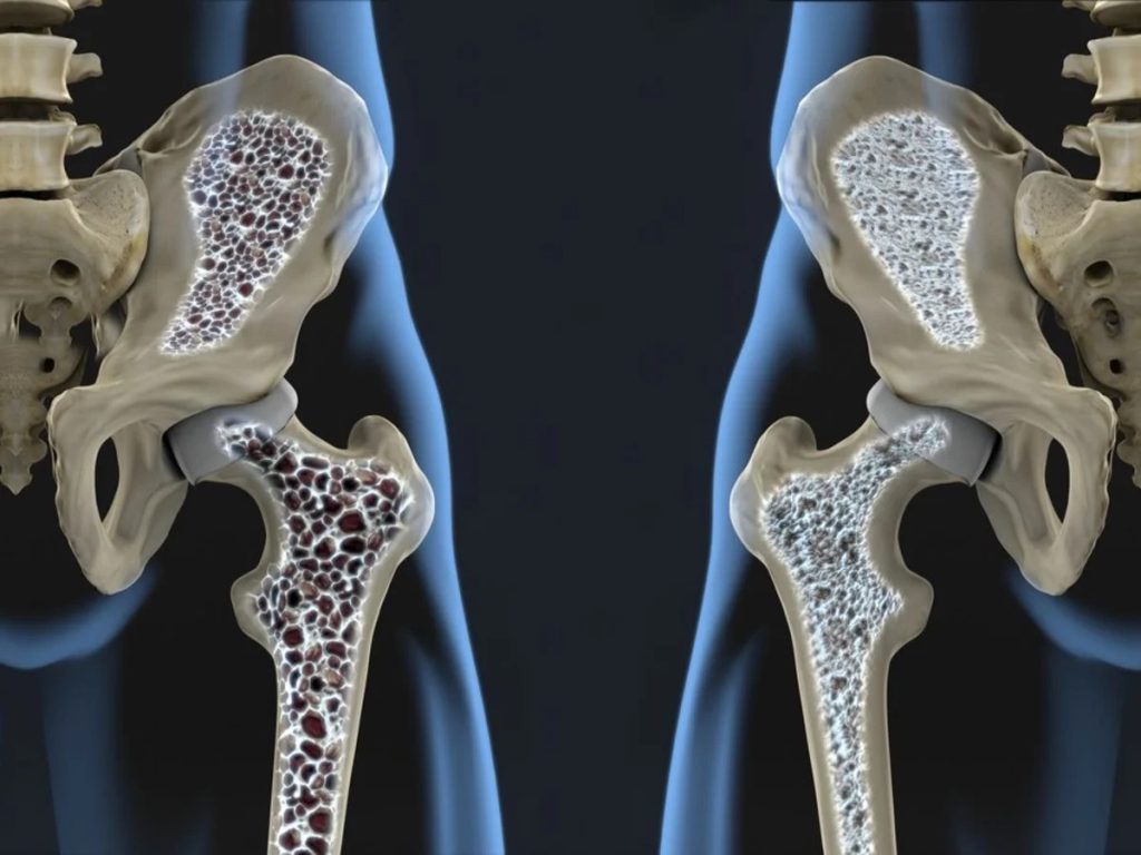 Día Mundial de la Osteoporosis